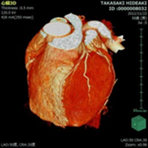 CT心臓_800